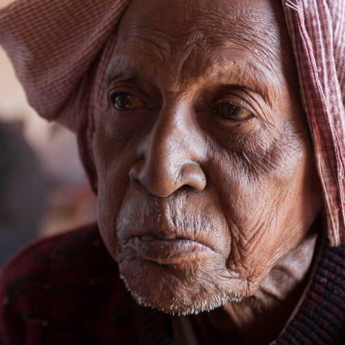 Elderly man suffering the mental effects of leprosy
