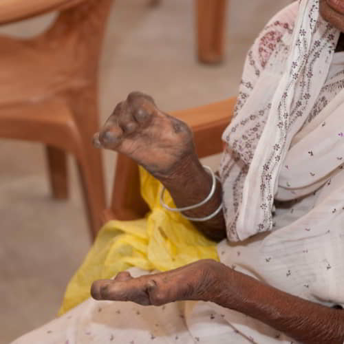 Elderly woman suffering the physical effects of leprosy