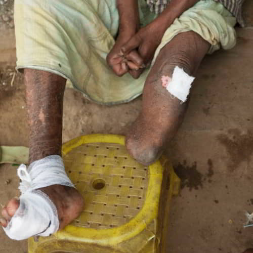 Leprosy patient's hands and legs deformed by the disease