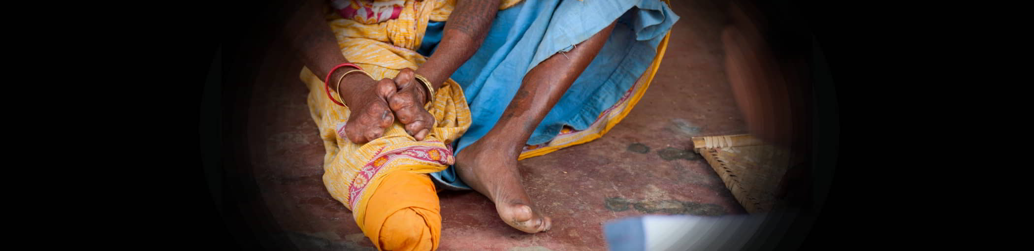 Physical Effects of Leprosy