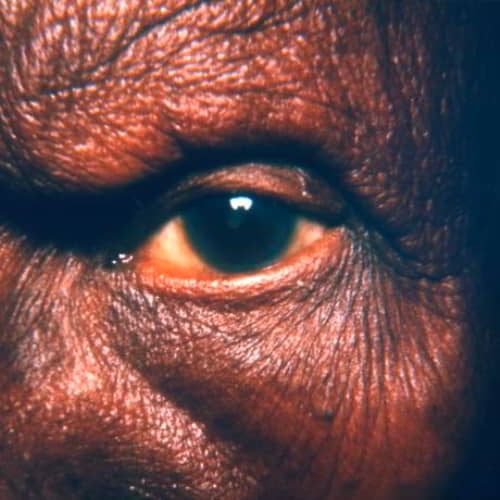 Eye of a leprosy patient